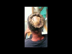 Myiasis maggots in man´s head - viewer discretion advised!