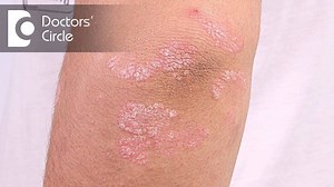 How to treat chronic Psoriasis not responding to treatments? | Doctors' Circle
