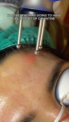 The newest erbium YAG resurfacing laser with a built in smoke evacuator (very important) is now at Dr Ammarah Saad Hashmi’s clinic in Islamabad. Also called the ‘The Cool Laser’, it reduces acne scars, fine lines, wrinkles and leaves skin radiant and glowing. @ammarasaadhashmi @aestheticlifepakistan @asclepion_laser_technologies | Academy of Aesthetics