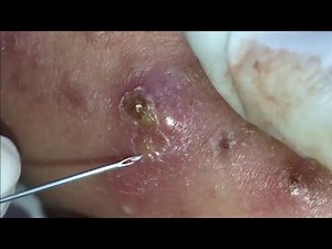 Satisfying Videos | Pimples Popping - Blackheads - Acne & Cysts #118