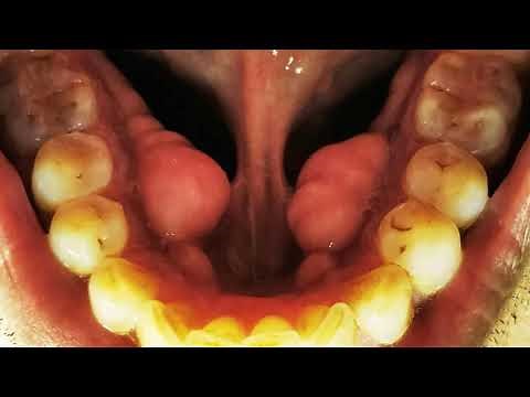 Mandibular Tori - Dr Amit Mohan