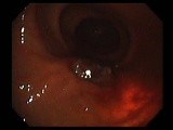 Gastrointestinal Stromal Tumor - GIST (17 of 65) • Video • MEDtube.net