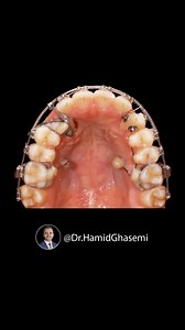 Bilateral Impacted maxillary canine 🦷 . By @dr.hamidghasemi . . #impacted #orthotech #orthodontic #caninetooth #ortholove | Dentistry blog