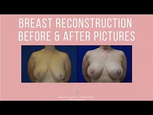 Breast Reconstruction Before & After Pictures | Photo Gallery