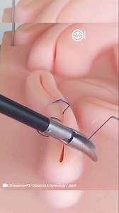 Laparoscopic Suture Techniques. Great Master shows different types of laparoscopic suturing techniques. #medical #laparoscopy #masterclass #reelsvideo | SurgMedia