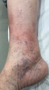 Lipodermatosclerosis and corona phlebectatica. | Vein Treatment Center | Facebook