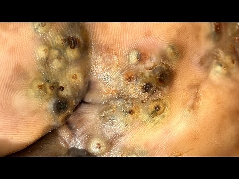 Charles’s left foot - WORST JIGGER ATTACK EVER, watch full video @riseupsociety.net