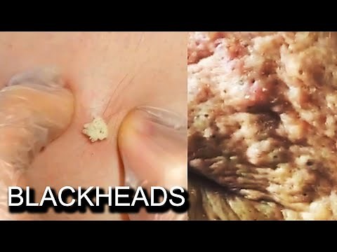 Comedone, Comedones, Open and Closed Comedones! Plus Blackheads (Documentary)