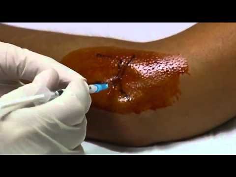 Gomito: video tecnica infiltrativa