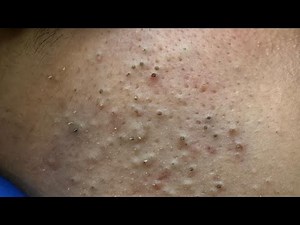 [ASMR] Pimple Popping and Deep Cleansing Facial Therapy