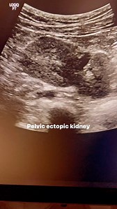 Renal ectopia #pelvickidney #renalectopia #renaldisease #renalultrasound #kidneyultrasound #ultrasoundmadeeasy | Ultrasound made easy
