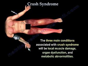 How to Recognize and Treat Crush Syndrome After Building Collapse, War, and Disaster Injuries