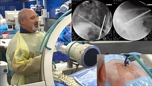 Sacroplasty Access Using the Long Axis Technique