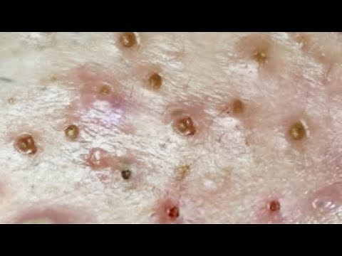 popping pimples on her face very satisfying Blackhead