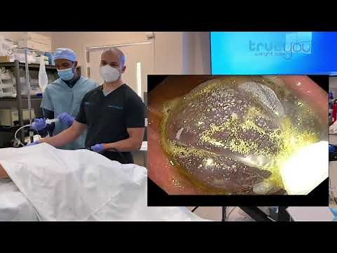 Orbera Balloon Placement | Full Educational Endoscopic Demonstration