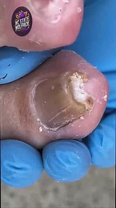 Hygienic Toenail Cleaning Methods for Thick Nails 🍉 #EverydayCare #FootSupport #SeniorHealth | NC State Wolfpack on TheWolfpacker.com