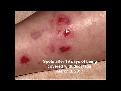 My DSAP Treatment Story