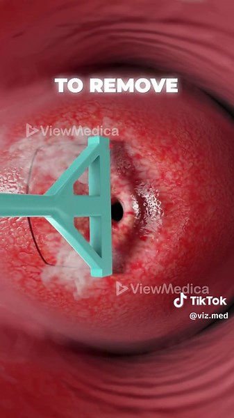What is LEEP and why is it important? #leep #cervix #cervicalcancer #womenshealth #3dmedicalanimation #medicaleducation #3danimationsurgery