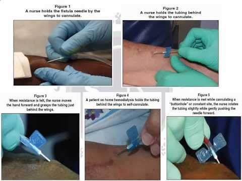 Vascular Access Cannulation Skills and Techniques