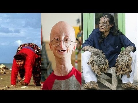 10 Most Bizarre Genetic Mutations in Humans - AllTimeTop