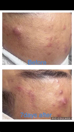 2.9K views | Acne treatment! Trust the process ,trust the Sueing way! | Sue-Ing House of Beauty and Wellness | Facebook
