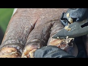 Healing the Least of These: Fighting Jiggers with Christ’s Love