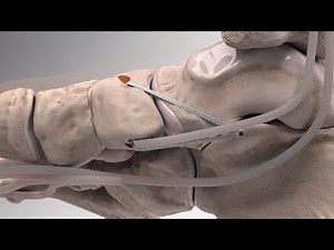Flatfoot Repair with Arthrex® InternalBrace™ Augmentation