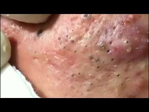 Best Blackhead Removal Ever 2020