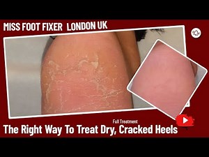 The Right Way To Treat Dry, Cracked Heels Full Treatment By Miss Foot Fixer