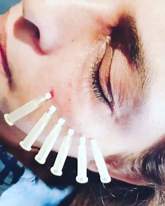 #PCL #screwthreads #undereyes to smooth out lines, to tighten up under eye creepy skin, to build up more collagen.. For appointments Contact us Lahore 03314303938 923434551576 Karachi 03343785123 | Expression Aesthetics