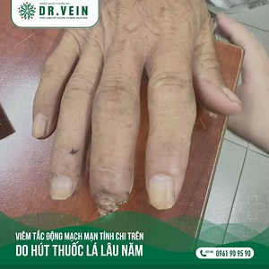 SMOKING CAUSES LIMB NECROSIS DUE TO THROMBOANGIITIS OBLITERANS ⚠️⚠️ 👨‍🦳 Patient: ▪️ Elderly male ▪️ Long-term smoker 🩺 Diagnosis ▪️ Thromboangiitis obliterans (Buerger's disease) of the upper limb 👎 Long-term exposure to cigarette smoke damages the blood vessel lining, leading to: ▪️ Thromboangiitis obliterans ▪️ Ischemia ▪️ Limb necrosis 👉 Recommendation: ▪️ Quit smoking immediately 🚭. (Continued smoking can lead to the spread of the condition to other fingers) ------ HÚT THUỐC LÁ GÂY HOẠ