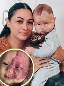 Als die Frau ihren Sohn zur Welt brachte, war sein halbes Gesicht von einem großen Muttermal bedeckt, und es war sofort klar, dass ihm ein schwerer Weg bevorstand. 😲😱 Ihr werdet nicht glauben, was sie durchgemacht hat – und wo ihr Sohn jetzt steht. Nach Jahren der Kritik und Behandlung wird euch die Enthüllung der Verwandlung ihres Sohnes sprachlos machen. 😲 Seht in den Kommentaren, wie er heute aussieht. 👇👇👇 | Promi-Tratsch