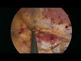 Laparoscopic Triple Neurectomy for Cronic Pain After Inguinal Hernia Repair • Video • MEDtube.net