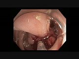 Colonoscopy - Sigmoid Polyp 3 - Epinephrine Injection • Video • MEDtube.net