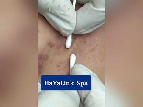 Nặn Mụn Phan Thiết | 137 | HaYaLink Spa
