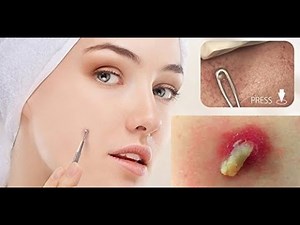Whiteheads Blackheads Removal Instruction Video Pimple Zit Extractor in action
