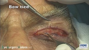 Ptosis - involutional - correciton, anterior approach levator aponeurosis advance - Oculoplastic | EyeSurgeryVideos.net