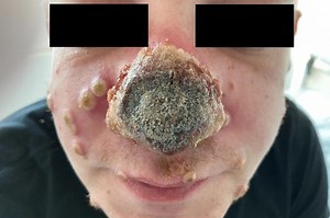 Woman shares her experience with monkeypox – and claims it didn’t come from sex