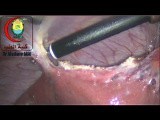 After Securing the Cystic Duct and Artery You Have To Do Adhesiolysis • Video • MEDtube.net