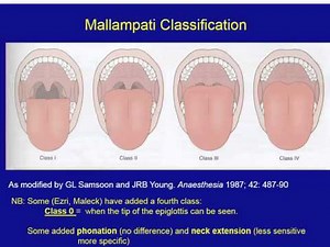 20150817 Preparation and Mgmt Known Difficult Airway