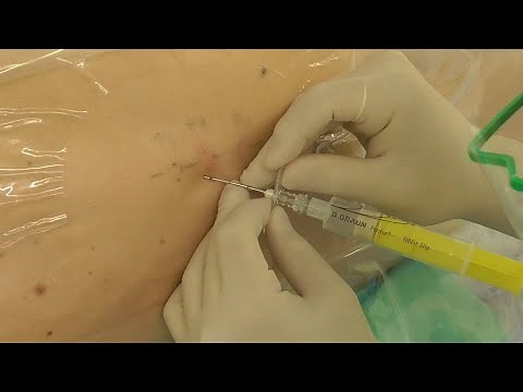 【神経ブロック】硬膜外麻酔_傍正中法