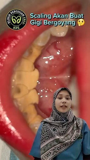 Scaling gigi merupakan pembersihan karang gigi oleh doktor gigi yang disebut “scaling”. Ianya menggunakan alat khusus yg disebut scaler. Karang gigi boleh menjadi penyebab bau mulut! 濫 Oleh sebab itu, membersihkan karang gigi perkara yang perlu kita lakukan, terutamanya untuk menjaga kesihtan gigi dan mulut secara menyeluruh. ☺️ #seo #fyp #dentist #dentistmalaysia #dentisthumor #nursedental #klinikpergigianerfamelawati #klinikpergigianerfacheras | Klinik Pergigian Erfa | Facebook