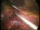 Total gastrectomy with D2 Resection - Laparoscopic Approach • Video • MEDtube.net