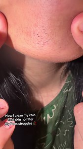 PCOS Chin Care: Gentle Skin-Cleansing Tips