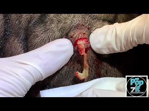 “Yellow worm” Pilar cyst #6 cyst pop and removal. Excision and removal of firm Pilar cyst of scalp