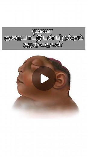 Dr. Isacc Abbas on Instagram: "In this video Dr.Isacc Abbas has explained about the Neural tube defects in newborns resulting from failure of the neural tube closure during embryogenesis. It is established that folic acid supplementation decreases the prevalence of this problem. Literature references- National Center on Birth Defects and Developmental Disabilities, Centers for Disease Control and Prevention Beckmann and Ling’s obstetrics and gynecology #babybrain #babyhealthcare #pregnant"