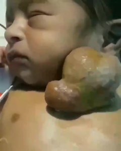 [ECTOPIA CORDIS] Dans l'ectopie cardiaque, le coeur est situé partiellement ou totalement en dehors de la cavité thoracique. Il s'agit d'une affection relativement rare, touchant une naissance sur 136.000. Elle s'accompagne fréquemment de malformations intra-cardiaques, qui grèvent le pronostic vital. Le traitement repose sur la prise en charge chirurgicale de ces malformations, parfois associé à une chirurgie de translocation cardiaque ! 😮 | EDN.fr - Le site de préparation aux EDN