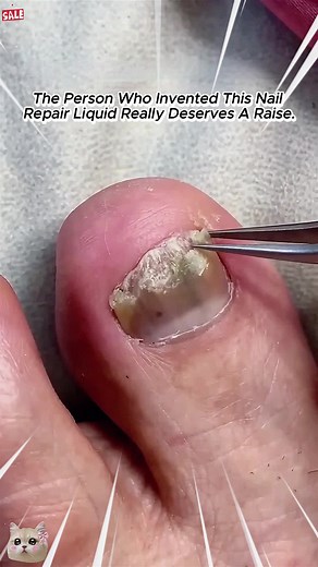 Nail Fungus Repair: Antifungal Treatment Guide