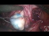 Locating Fibroids During Laparoscopic Myomectomy • Video • MEDtube.net