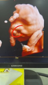 DETAIL SCAN BOLEH KESAN KECACATAN & KEABNORMALAN PADA BAYI DALAM KANDUNGAN . Pernah tak masa buat checkup bulanan dekat KK ke Hospital ke Klinik Swasta ke, Nurse atau Doktor akan suruh Ibu-ibu buat DETAIL SCAN? SEBAB APA PENTINGNYA BUAT DETAIL SCAN ❓ . ✅ Detail scan sangat penting untuk mengetahui perkembangan bayi ✅ Detail scan juga dapat mengesan kecacatan atau keabnormalan pada bayi ✅ Dengan detail scan juga kita dapat melihat semua struktur tubuh serta organ dalaman bayi seperti: otak, buah 